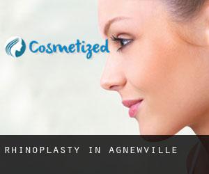 Rhinoplasty in Agnewville