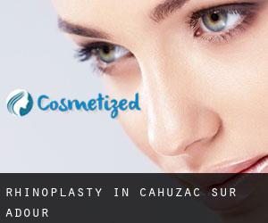 Rhinoplasty in Cahuzac-sur-Adour