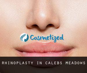 Rhinoplasty in Calebs Meadows