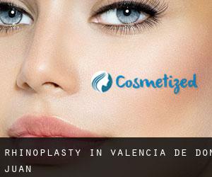 Rhinoplasty in Valencia de Don Juan