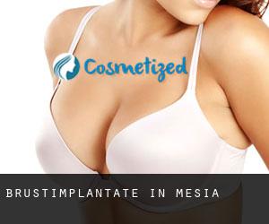 Brustimplantate in Mesia