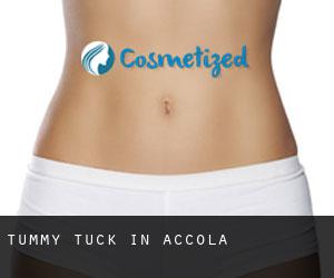 Tummy Tuck in Accola