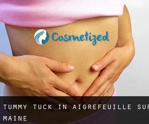 Tummy Tuck in Aigrefeuille-sur-Maine