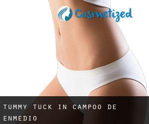 Tummy Tuck in Campoo de Enmedio