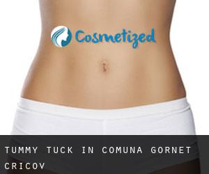 Tummy Tuck in Comuna Gornet-Cricov