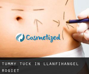 Tummy Tuck in Llanfihangel Rogiet