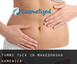 Tummy Tuck in Makedonska Kamenica